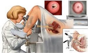 cac phuong phap phat hien som ung thu co tu cung